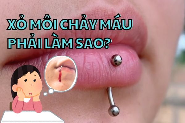 Xỏ môi bị chảy máu phải làm sao?