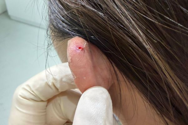 Xử lí lỗ xỏ bị bump tại nhà hiệu quả thường sau 2-4 tuần