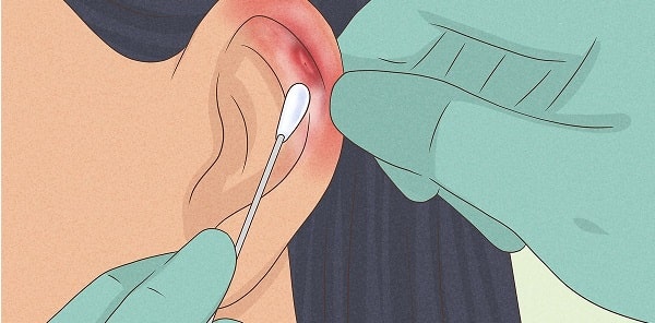 xử lý đeo bông tai bị chảy mủ