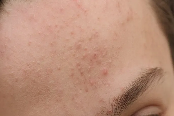 cách đẩy mụn ẩn