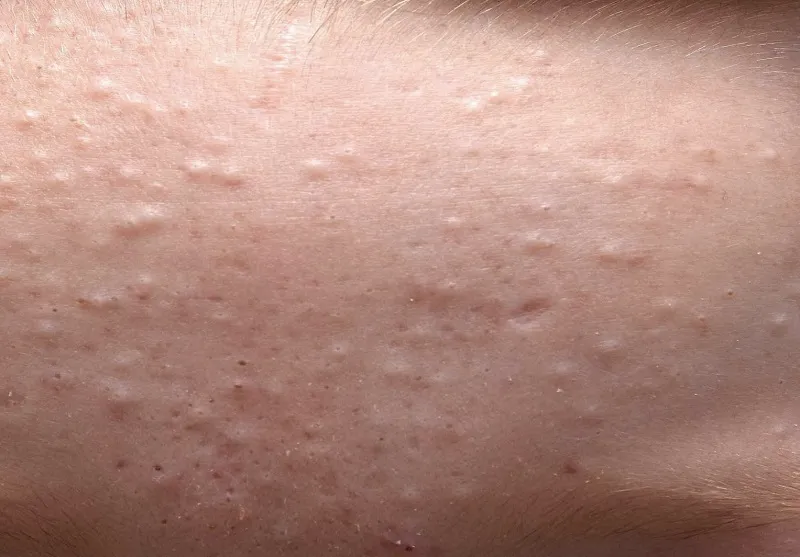 cách đẩy mụn ẩn