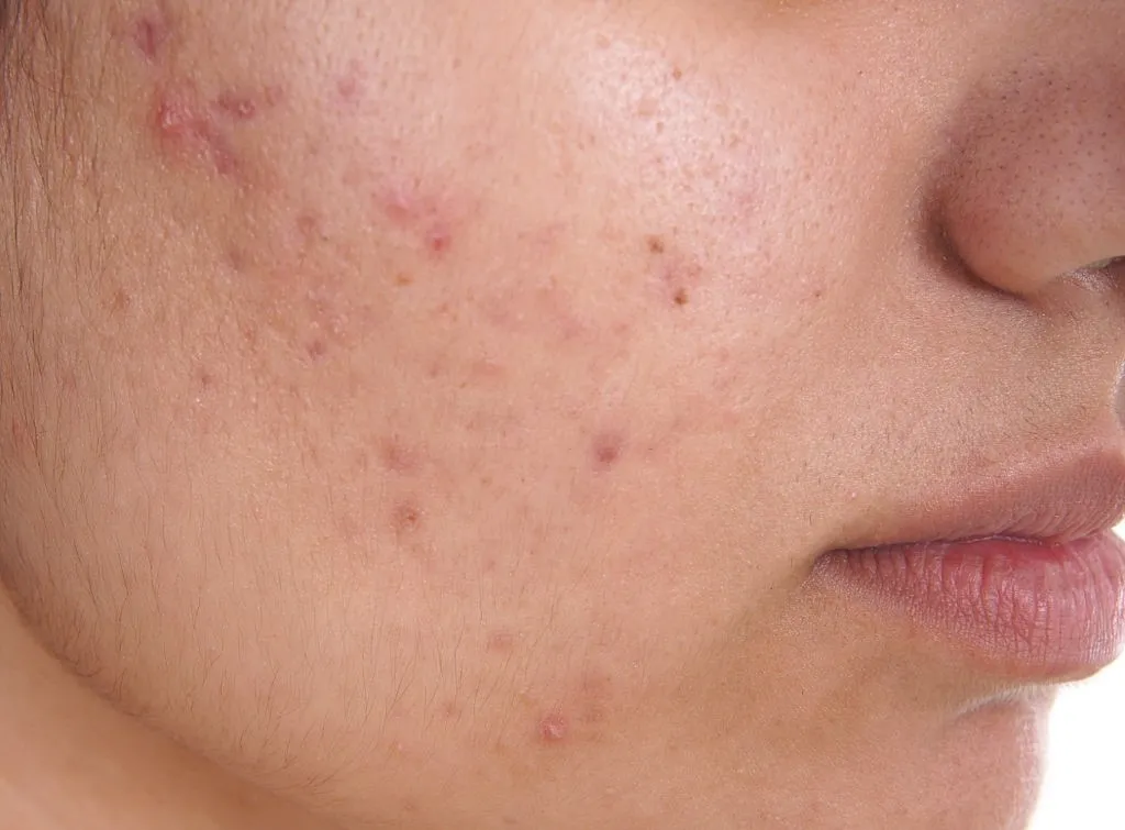 cách đẩy mụn ẩn