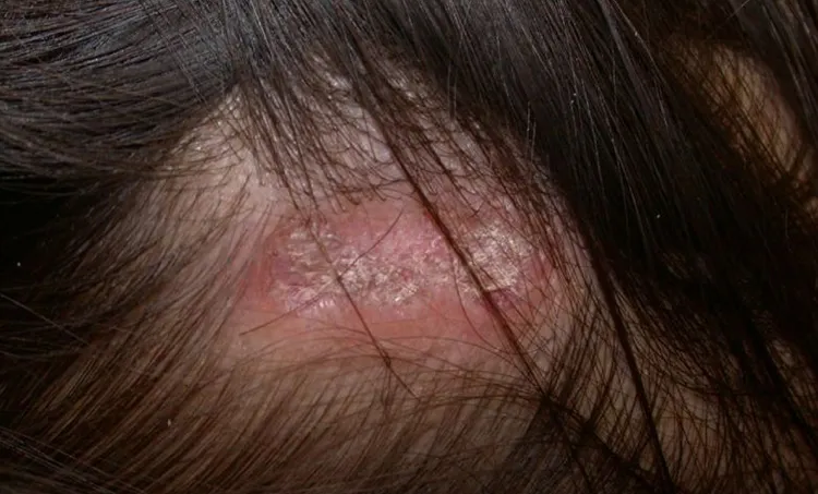 Rụng tóc từng mảng do Lupus ban đỏ