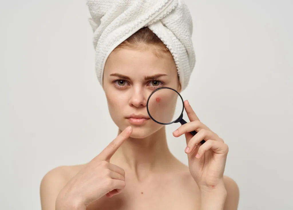 Skincare ban đêm cho da mụn sẽ giúp bạn điều trị mụn hiệu quả và nhanh chóng hơn
