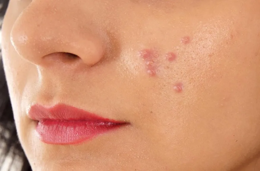 Mụn mủ gây khó chịu