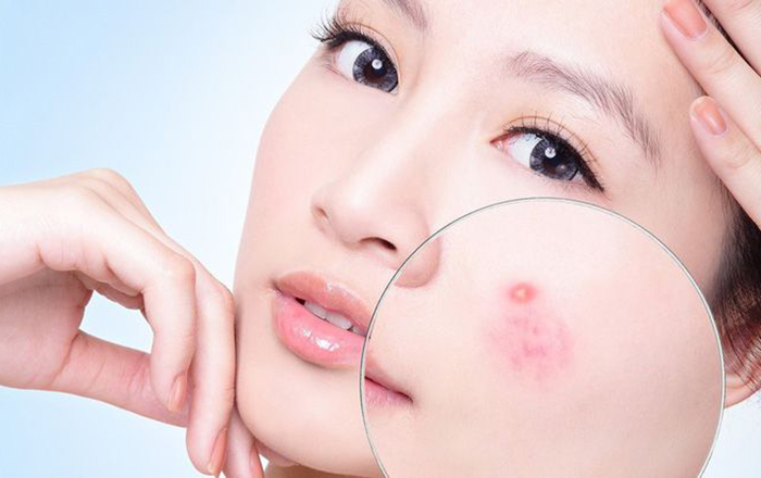 Tắc nghẽn lỗ chân lông - nguyên nhân làm mụn tái đi tái lại một chỗ