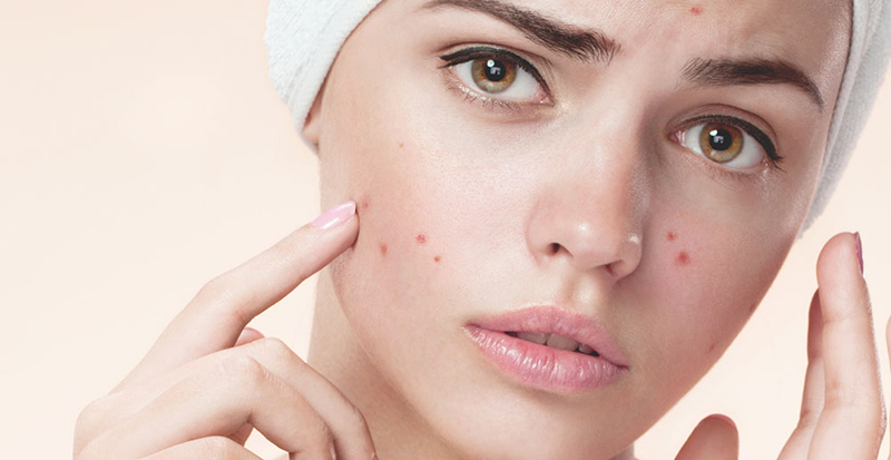 Sự cần thiết của việc chăm sóc mụn dậy thì cho học sinh sinh viên