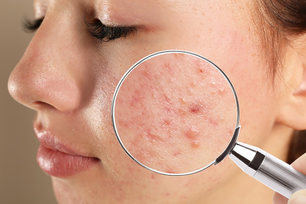 Mặt nạ dạng lột có gây tổn hại da?