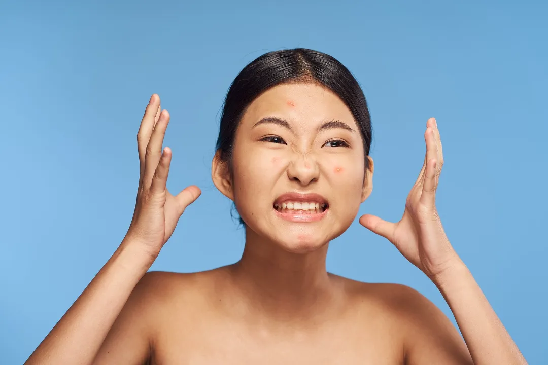 Stress cũng khiến bạn bị mụn - Cách giảm mụn ẩn