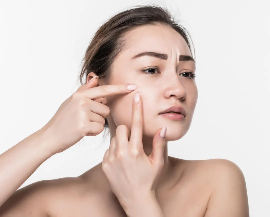 Không nên tự nặn mụn