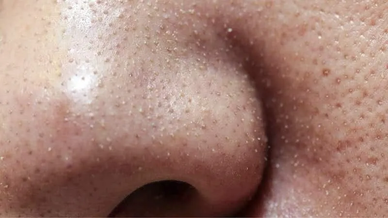 cách giảm sợi bã nhờn trên mũi