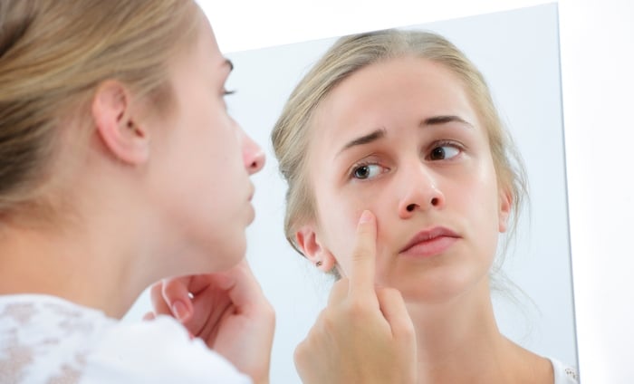 Giảm căng thẳng chính là cách không bị nổi mụn ở tuổi dậy thì