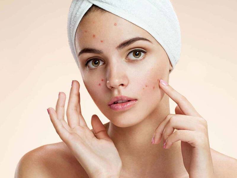 Mụn ẩn, hay còn được gọi là mụn nội tiết 