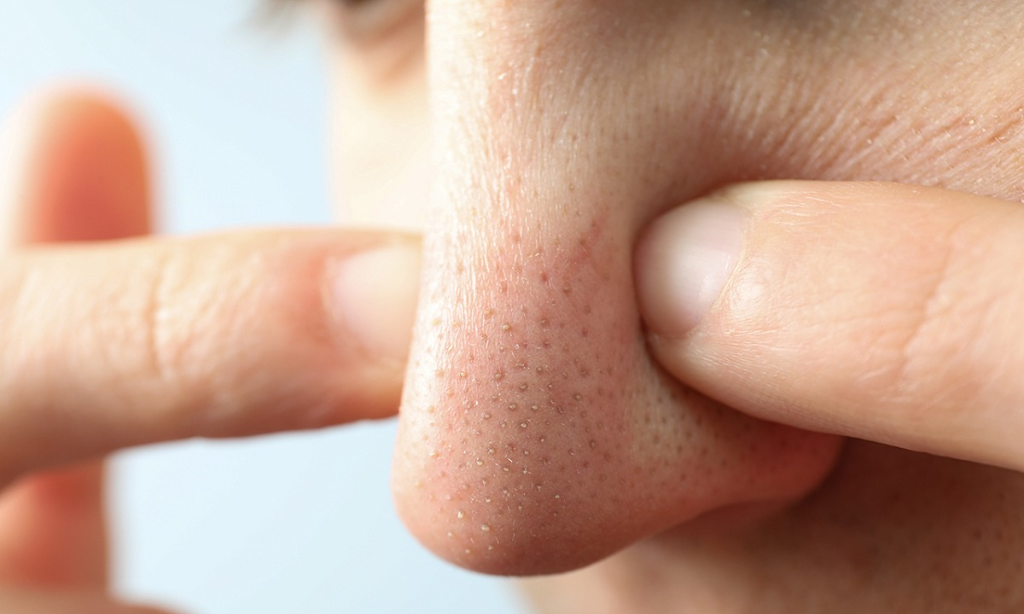 Dấu hiệu nhận biết mụn ẩn