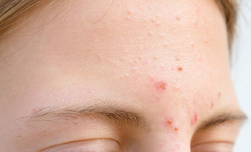 Khu vực thường tập trung mụn ẩn