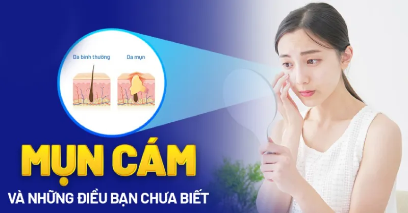 Mụn cám là gì?