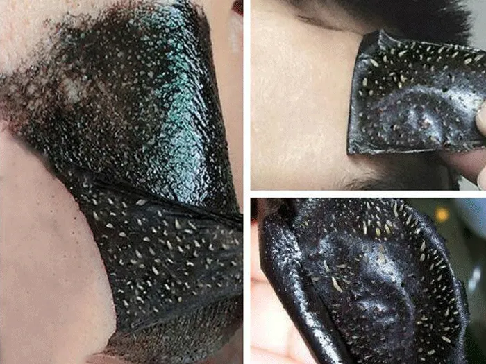 cách trị mụn đầu đen ở mũi