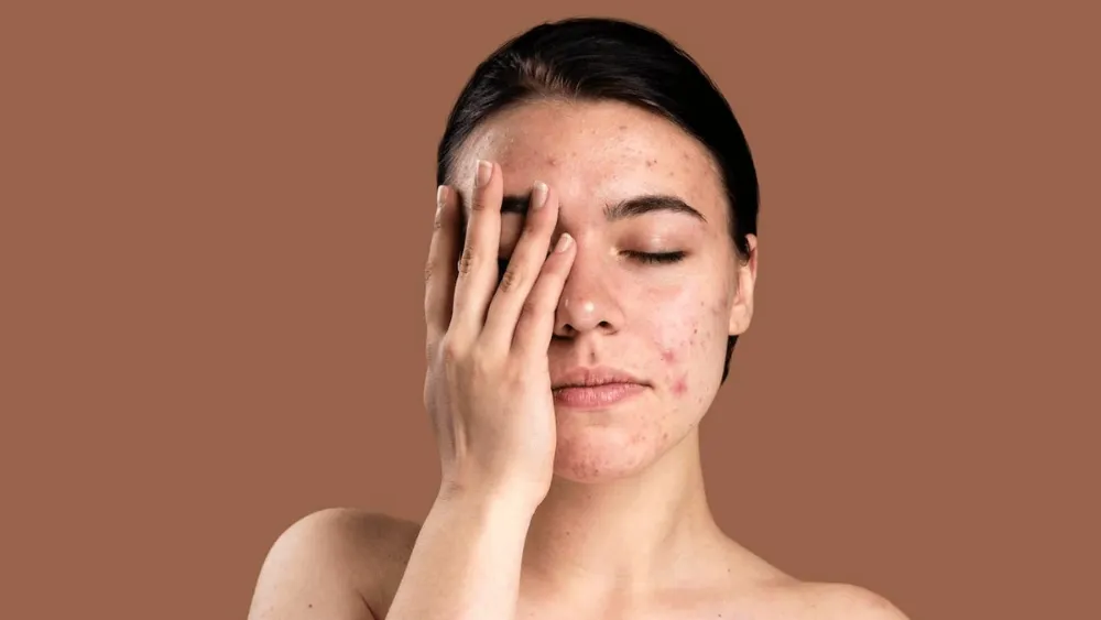 Tăng nguy cơ sẹo và thâm mụn
