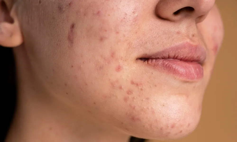 Viêm nhiễm có thể kéo dài