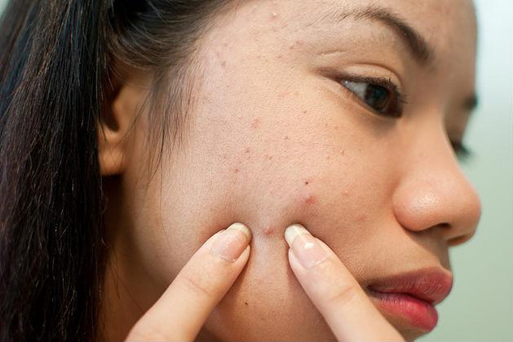 Nặn mụn sai cách sẽ khiến 2 bên má dễ bị mụn thâm đỏ hơn