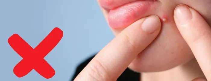 Không nên tự ý nặn mụn viêm đỏ không nhân