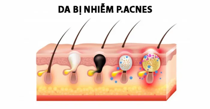 Vi khuẩn P.acnes gây mụn viêm trên da