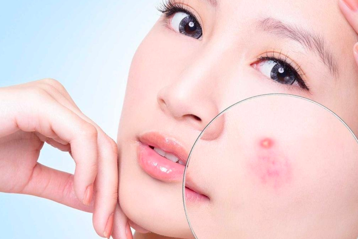 Mách bạn 5 cách trị thâm mụn nhanh nhất ngay tại nhà