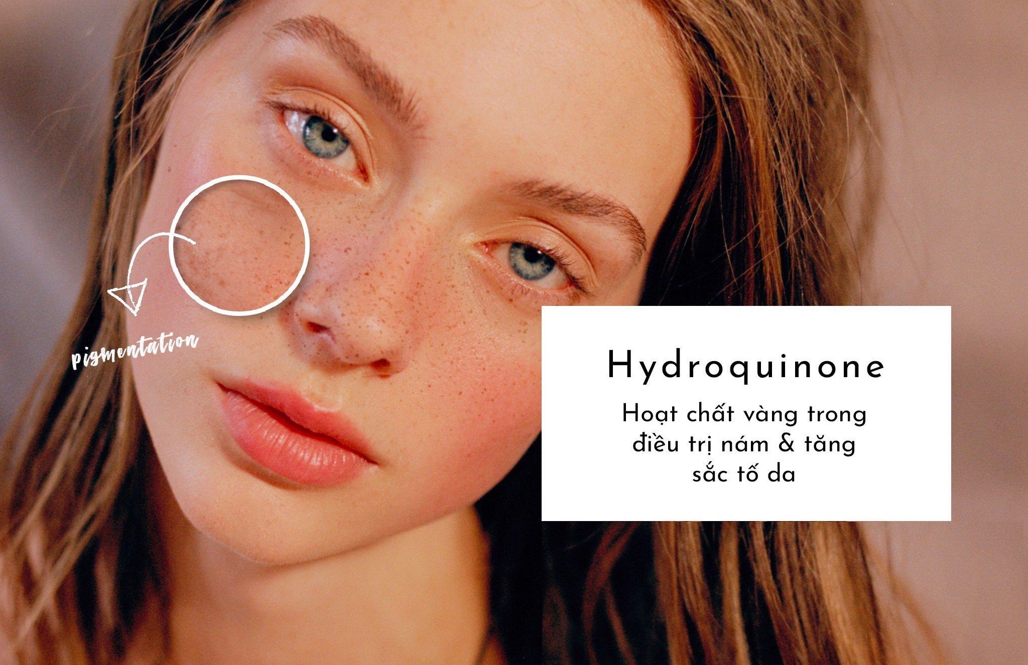 Sử dụng Hoạt chất Hydroquinone cũng là 1 cách trị thâm mụn hiệu quả