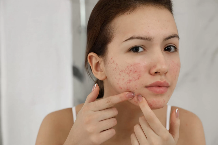 Tự ý nặn mụn sẽ khiến tình trạng mụn tồi tệ hơn