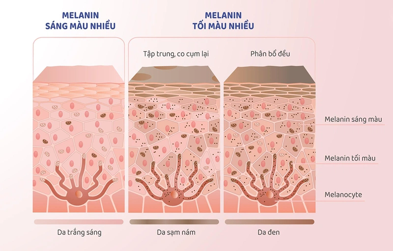 Melanin được sản xuất nhiều sẽ khiến da bị thâm