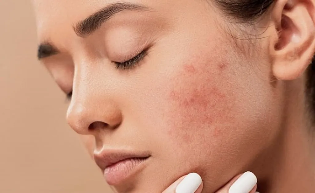 Tại sao cần biết cách vệ sinh da mặt khi bị mụn?