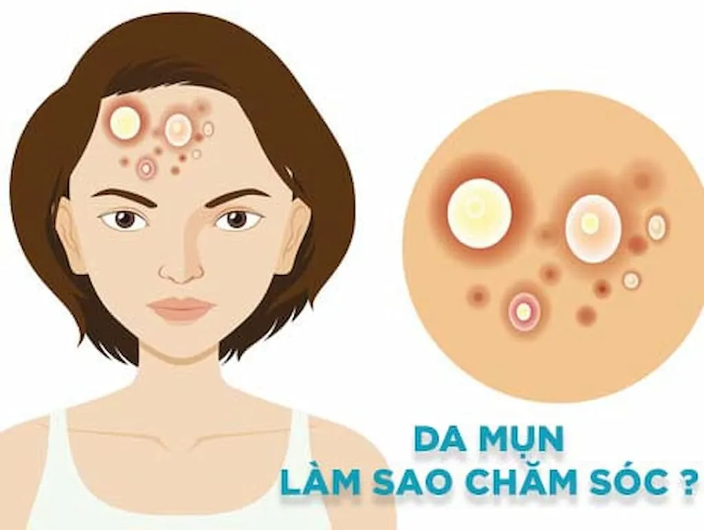 Cách vệ sinh da mặt khi bị mụn an toàn và hiệu quả