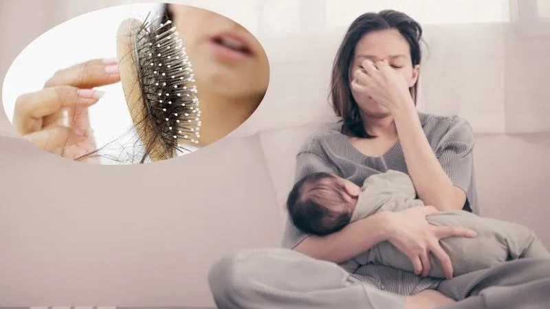 Rụng tóc sau sinh gây ra nhiều ảnh hưởng tới cuộc sống của các mẹ bỉm