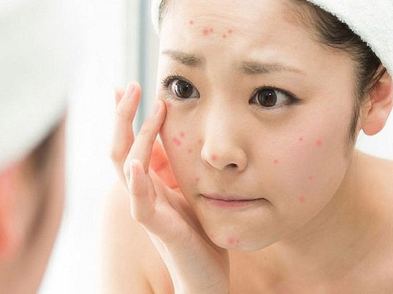 Sản phẩm uống hỗ trợ điều giảm mụn đang được nhiều chị em ưa thích 