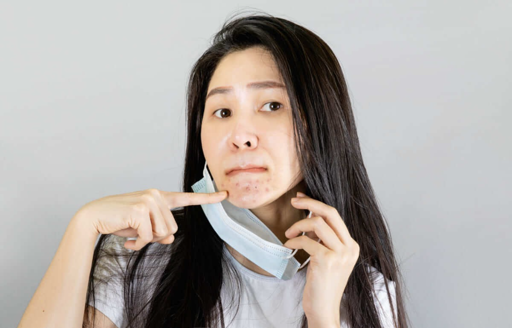 Tại sao đeo khẩu trang bị mụn?