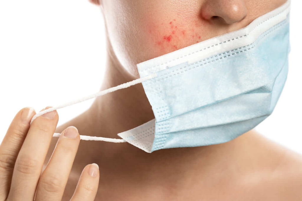 Da bị dị ứng khẩu trang