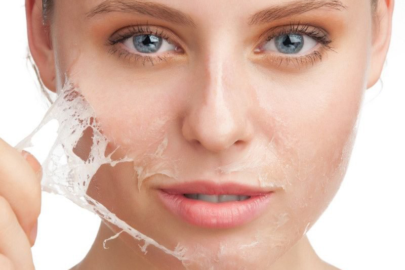 Trị mụn ẩn bằng liệu trình Peel da