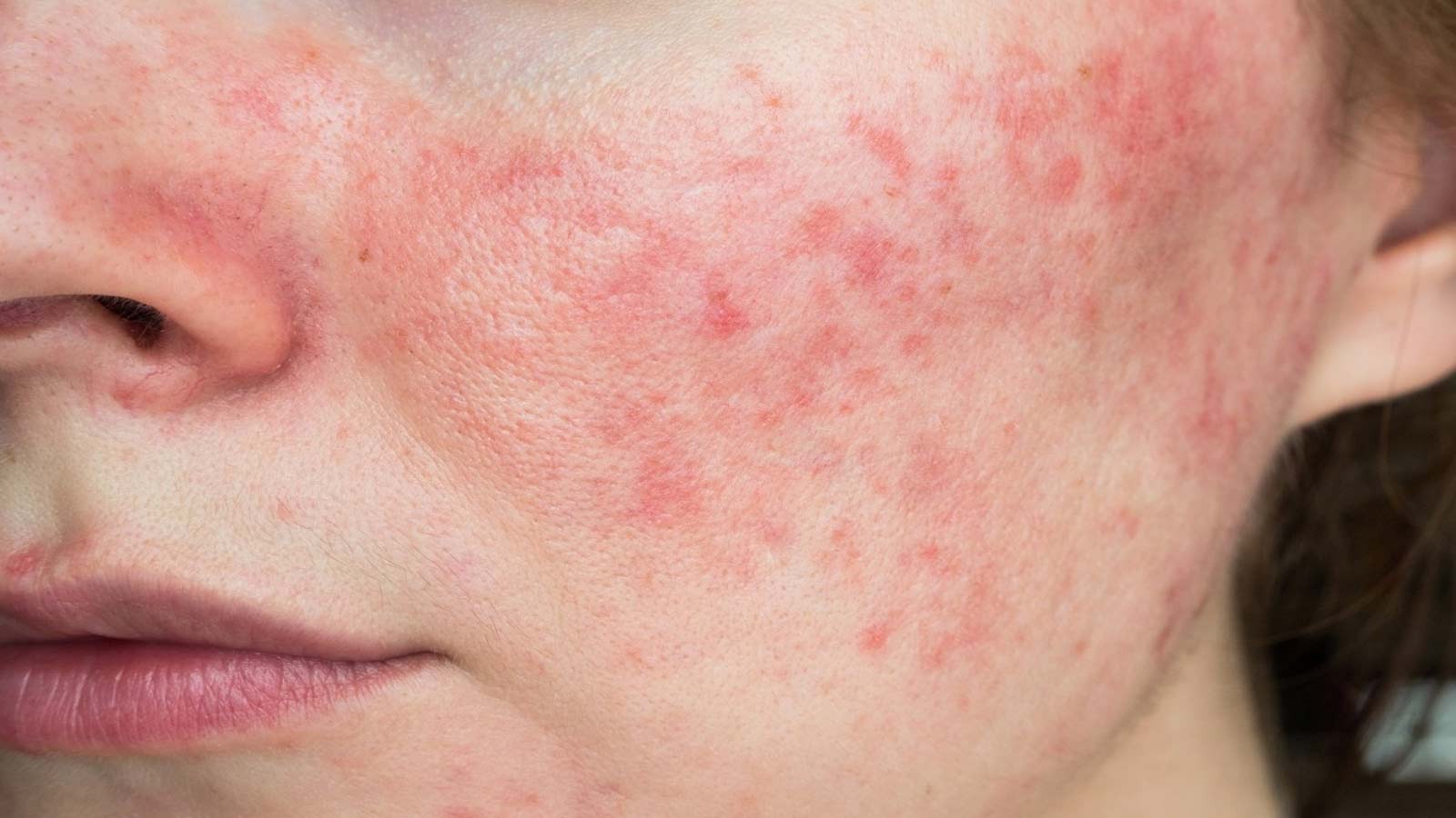 Dùng gel bôi mụn có thể giúp giảm viêm và làm dịu da