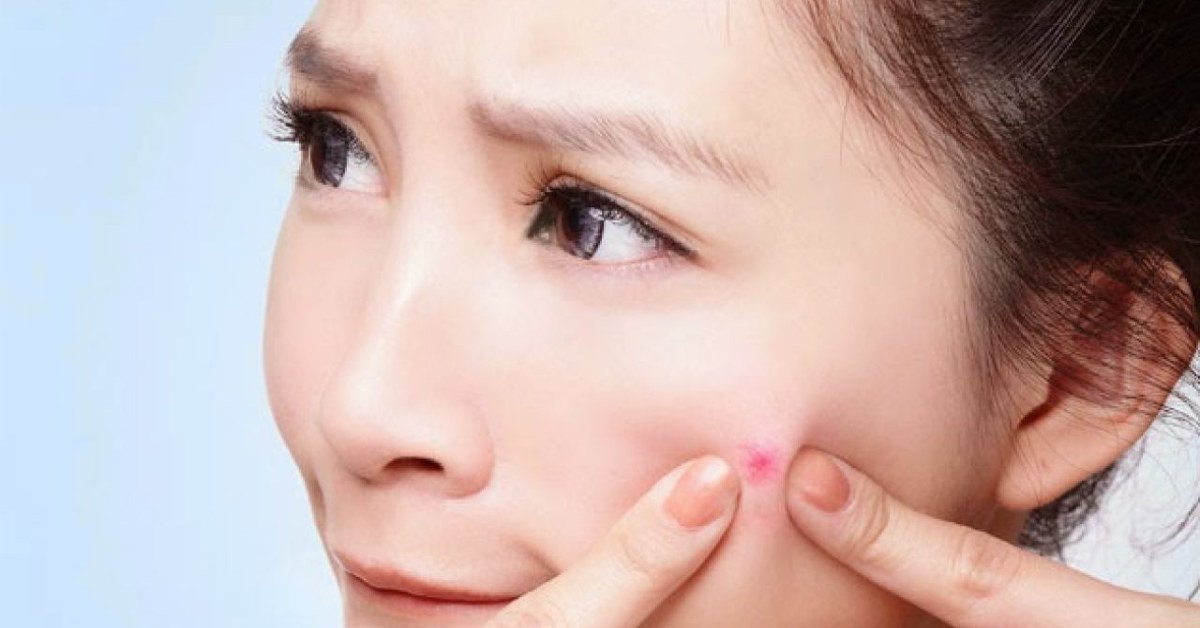 Nặn mụn sai cách có thể gây ra thâm mụn do làm tổn thương da và cấu trúc dưới da