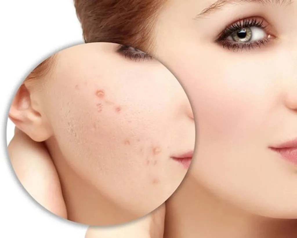 5 bí quyết đánh bay hết thâm mụn trong 1 tuần cực đơn giản | Actidem Việt Nam