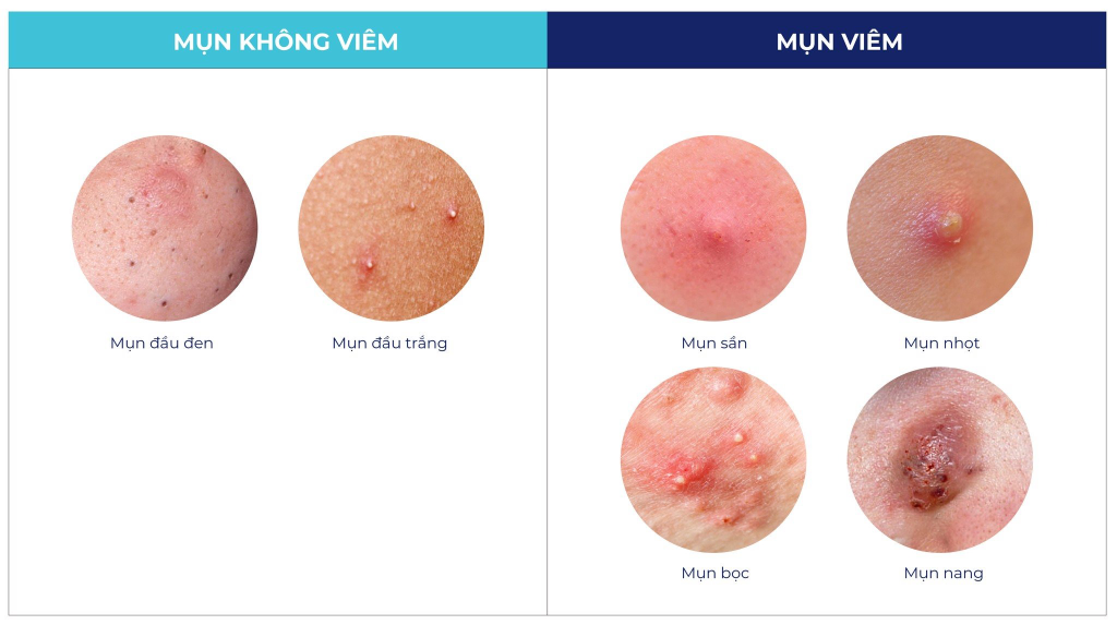Phân biệt các loại mụn?