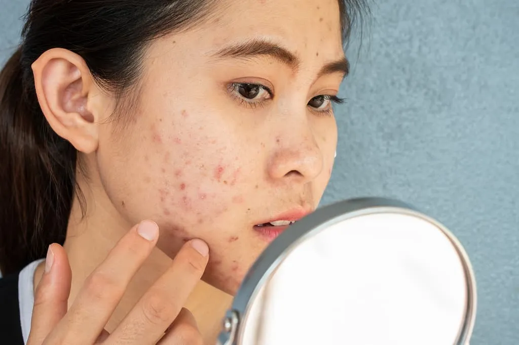 Tìm hiểu kem chấm mụn là gì?