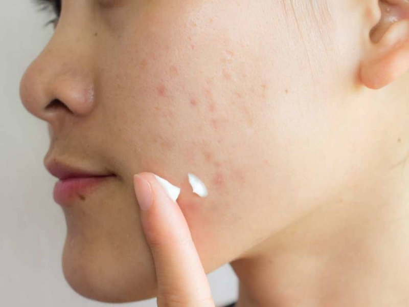 Lưu ý khi dùng kem giảm thâm mụn