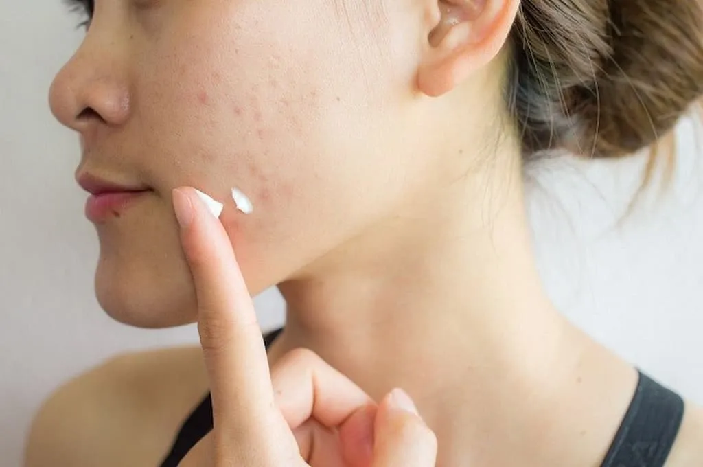 Lý do tại sao nên sử dụng kem trị mụn?