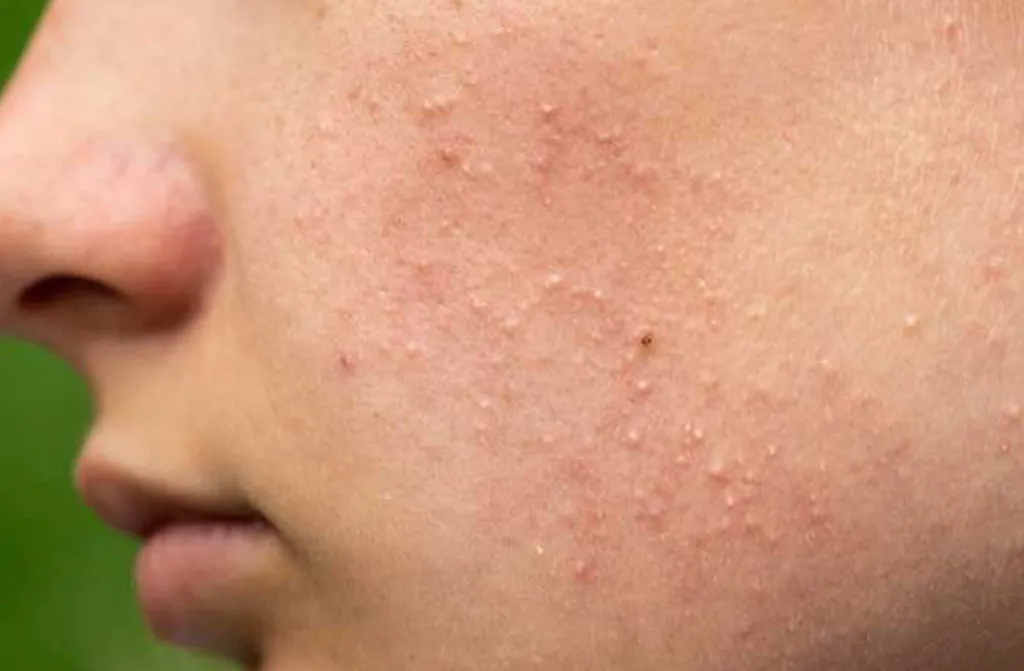 Tăng sản xuất dầu da gây mụn ẩn