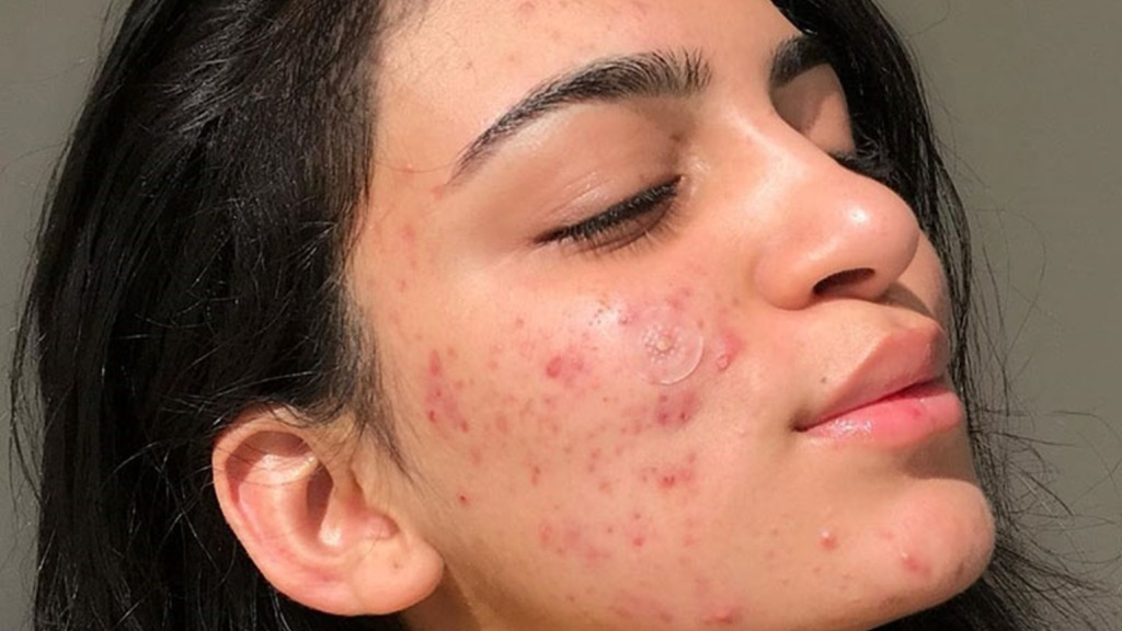 Nguyên nhân gây mụn tuổi dậy thì