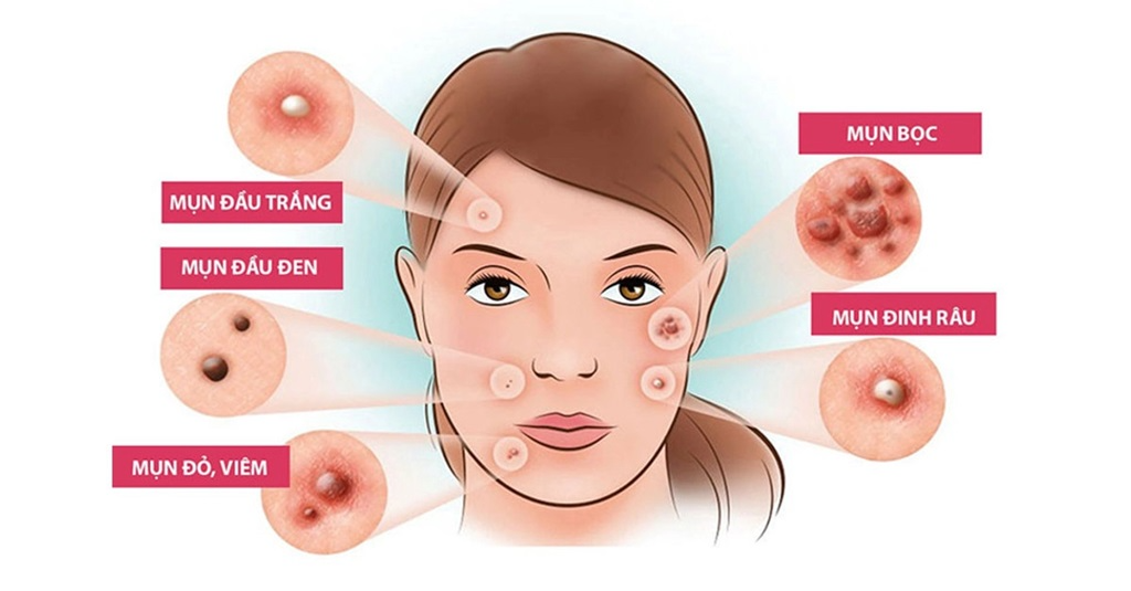 Các dạng mụn hay gặp ở tuổi dậy thì