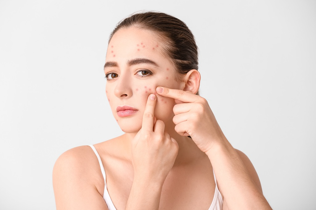 Lưu ý cách chăm sóc da mụn li ti