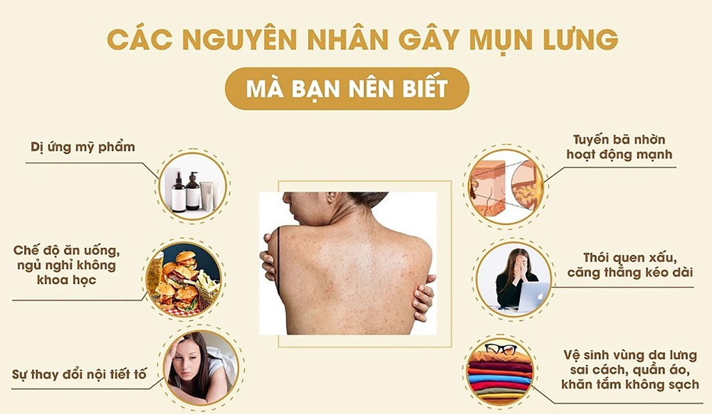 Nguyên nhân gây mụn ở lưng