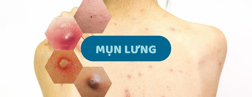 Phân biệt các loại mụn trên lưng